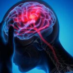 AVC mata uma pessoa a cada seis minutos no Brasil